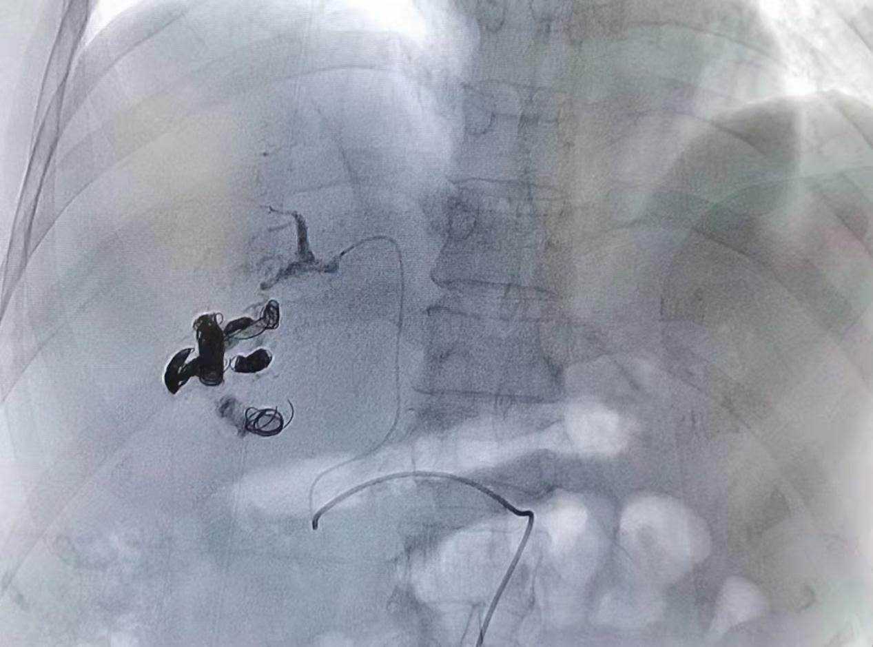 南昌大学二附院消化内科成功运用弹簧圈联合组织胶栓塞技术治疗一例高难度肝动脉-门静脉瘘患者