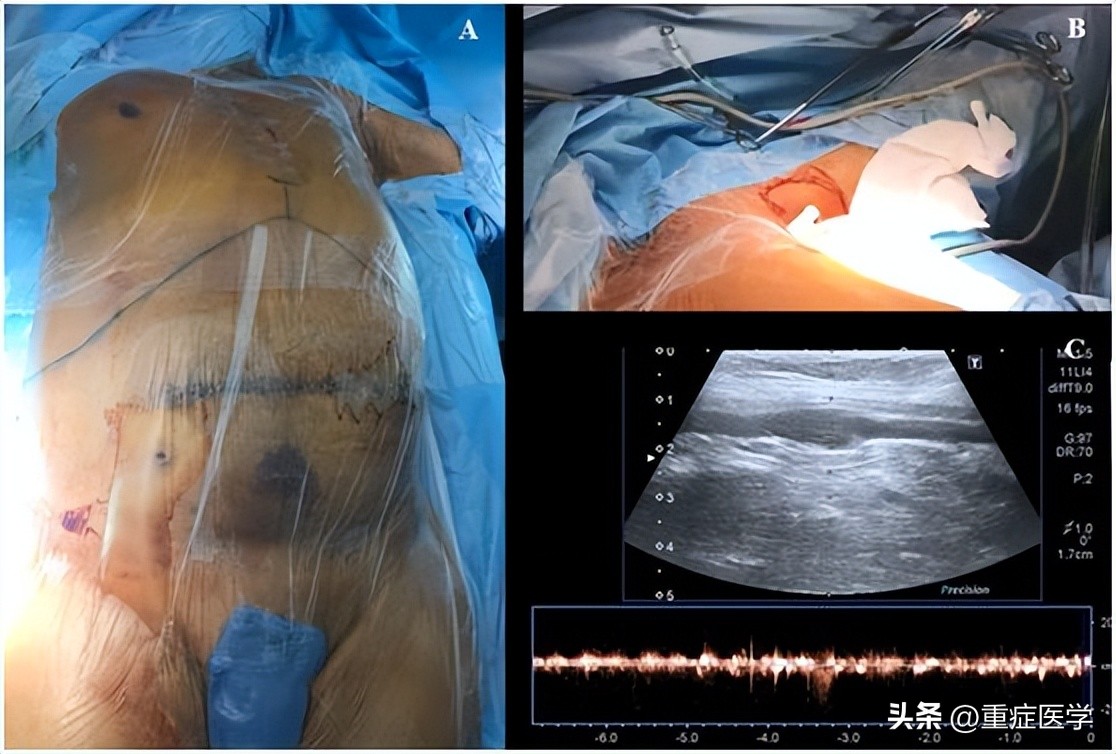 超声引导锁骨下静脉穿刺置管术,超声引导下腋静脉穿刺技巧