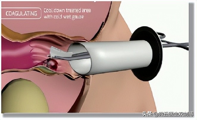 痔疮射频消融术适合混合痔吗,痔疮消融术的危害和弊端