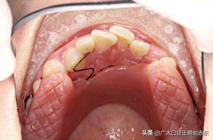 正畸整牙后遗症,正畸并发症