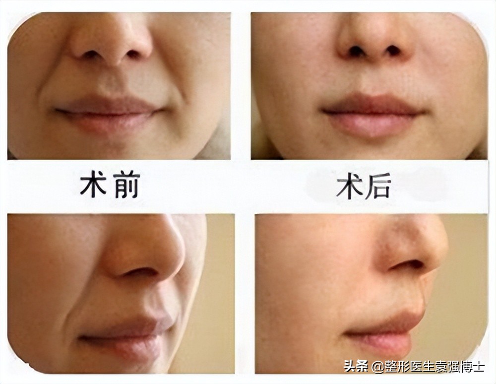 40岁去法令纹最好的方法,40岁就有很深的法令纹