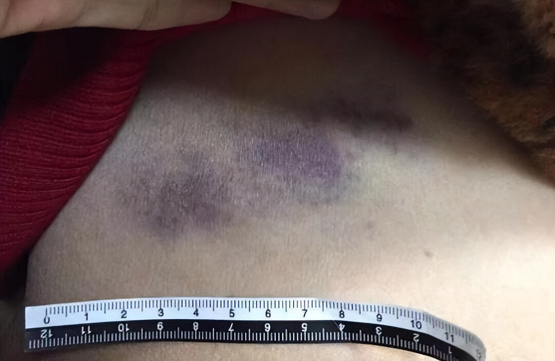 女子“变美”失败致器官病变：反遭牙博士100万索赔，去世父亲被诬告