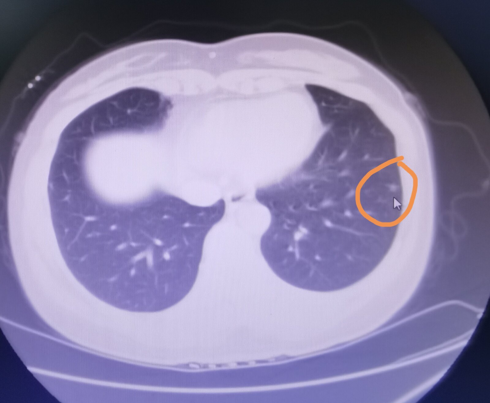 刘懿博士说肺原位癌,刘懿博士说肺癌脑转移