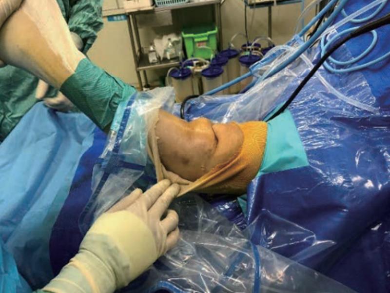 膝关节前交叉韧带损伤怎么治,十字交叉韧带损伤如何解决