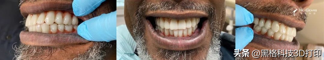 病例分享|美国BDG诊所实现全口即刻修复病例一则