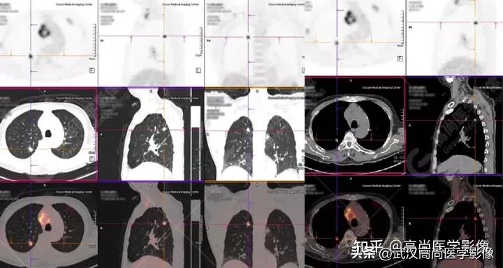10毫米的肺结节恶性死亡率有多大,1厘米多的肺结节良性可能性多大