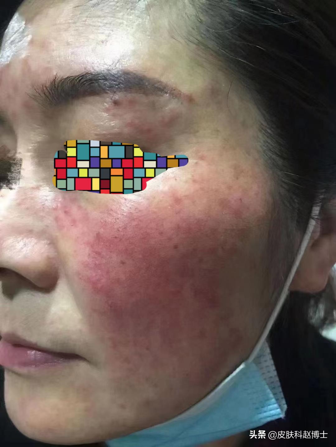 激素对皮肤病有效吗,皮肤科激素减量原则