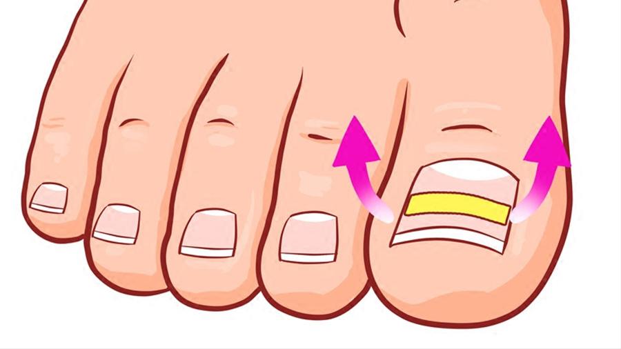 甲沟炎如何快速拔出脚趾甲,脚趾甲老往肉里钻一碰还疼