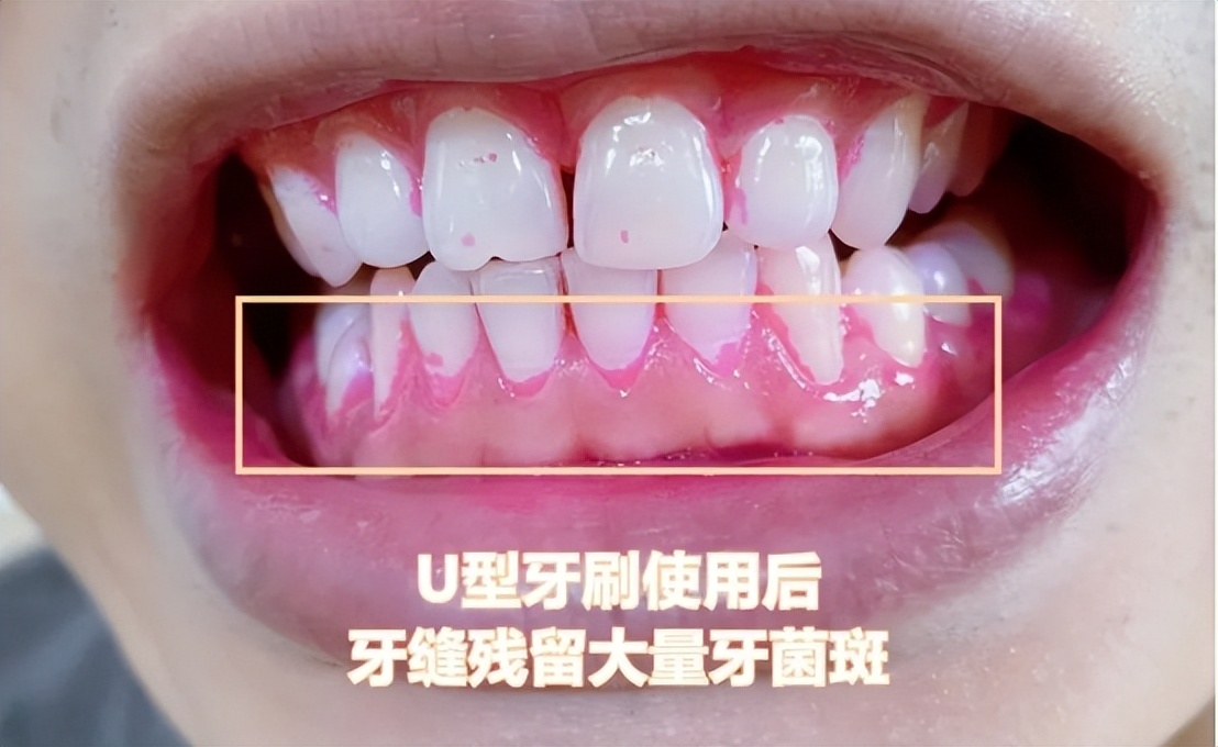 6岁儿童电动牙刷测评,儿童电动牙刷飞利浦和扉乐哪个好