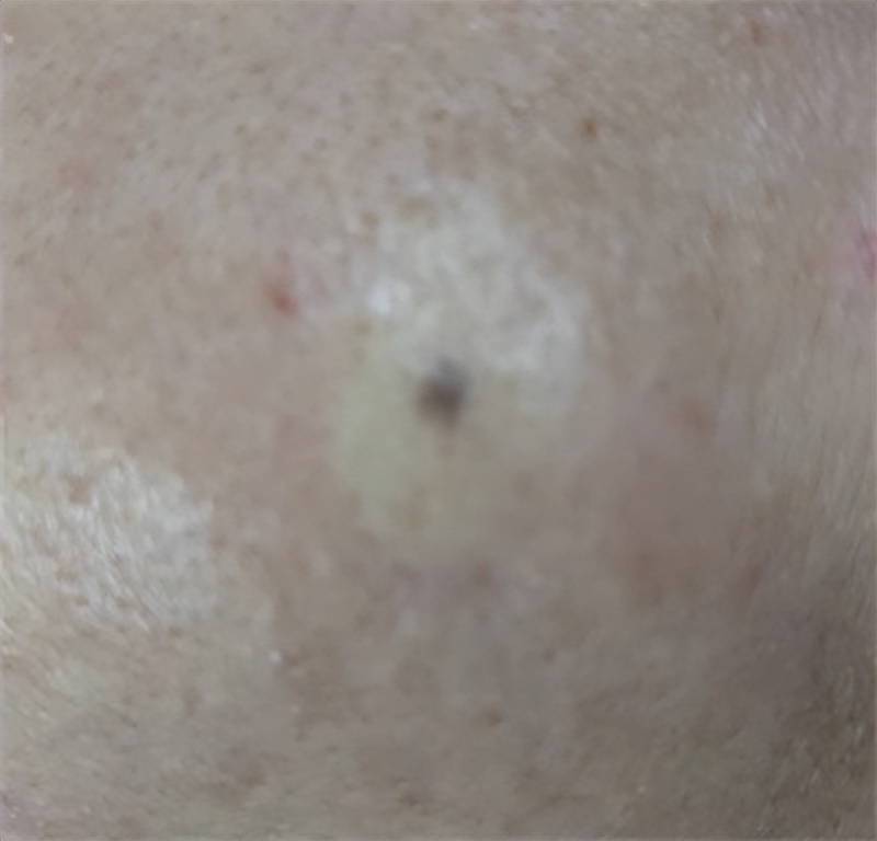 脸上的痣用激光点可以完全去除吗,脸上有痣激光去痣好还是药水点好