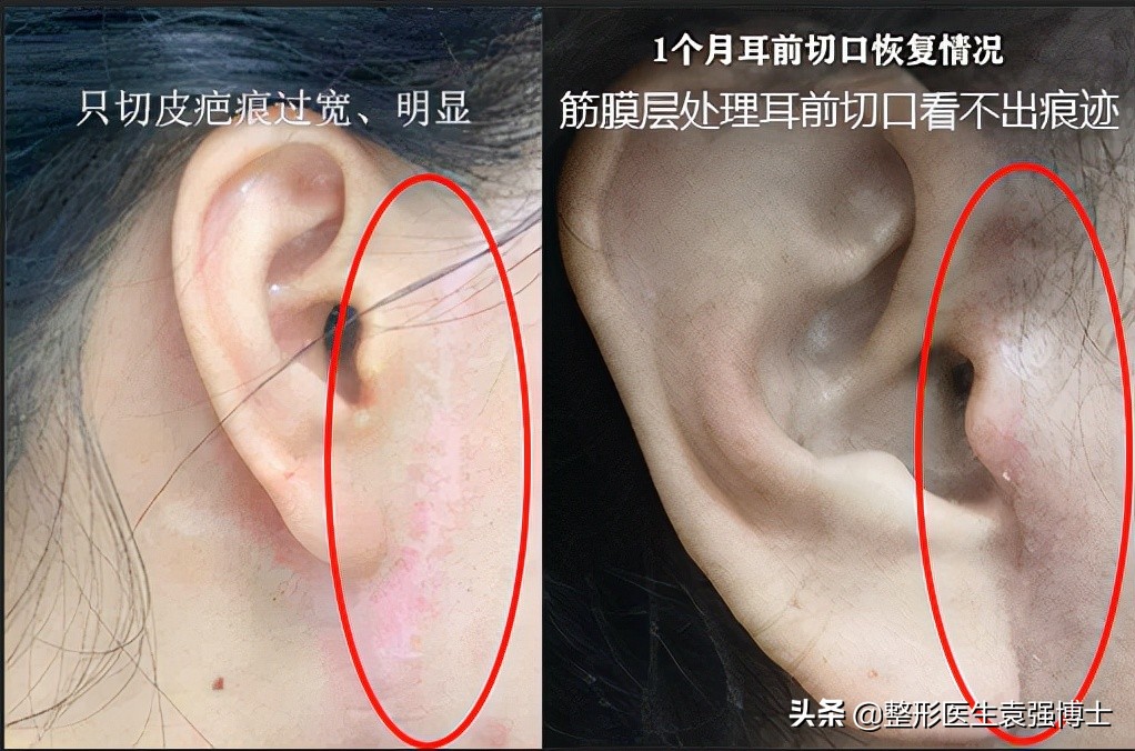 小切口面部提升能维持多久,面部提升的穴位手法完整视频