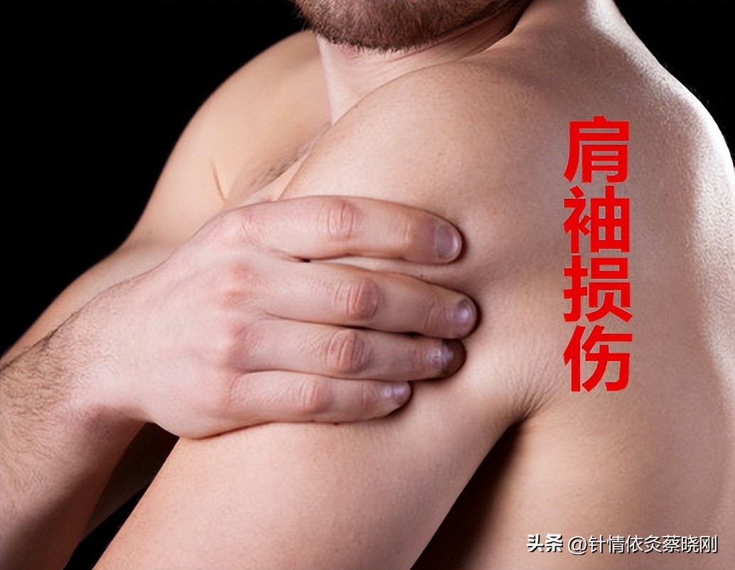 肩袖损伤针灸治疗可以吃药吗,肩袖损伤针灸特效穴