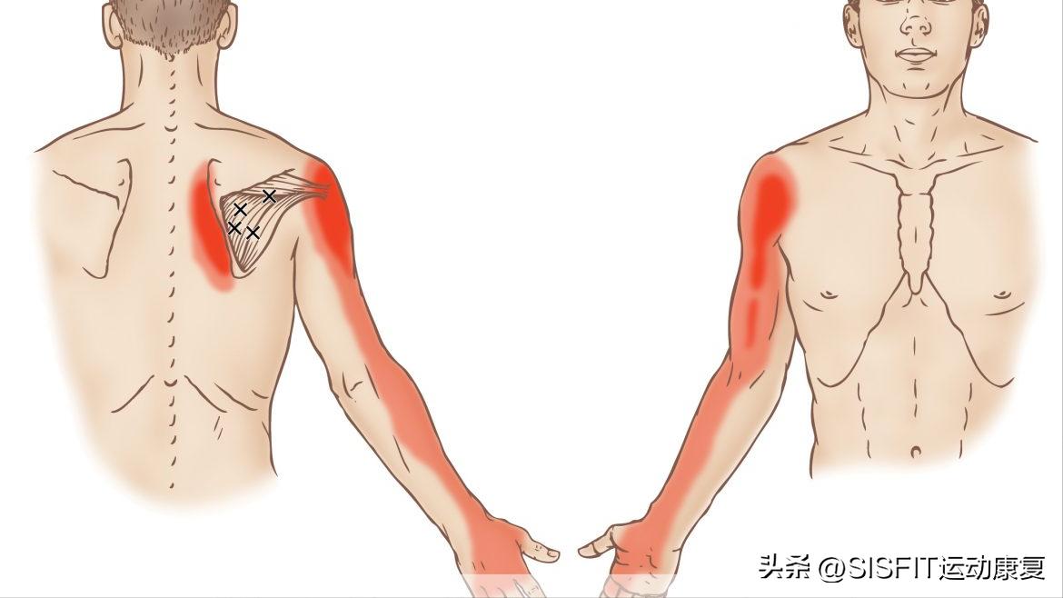冈下肌位置松解,冈下肌的松解手法
