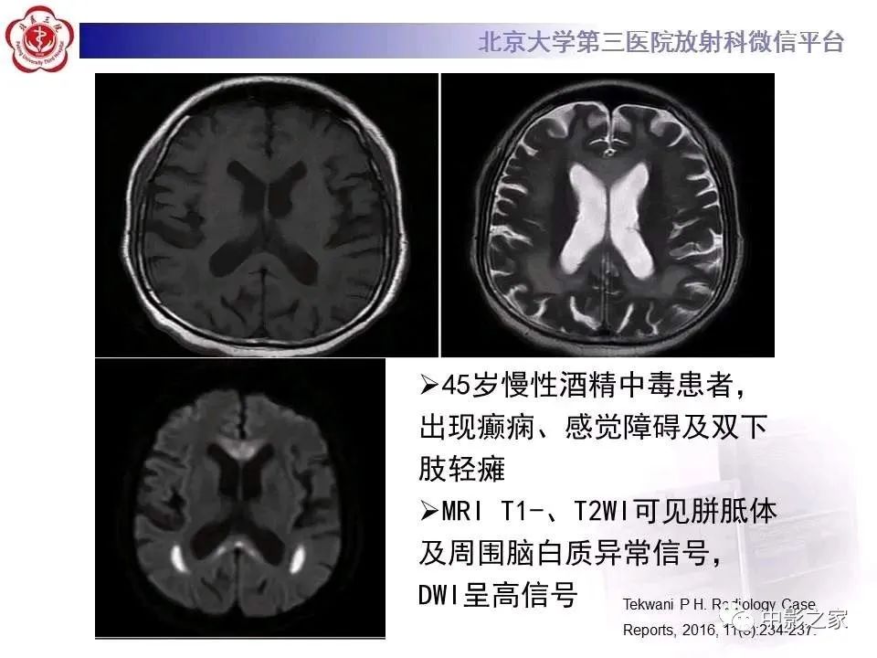 什么叫原发性胼胝体变性,原发性胼胝体变性治疗多少钱