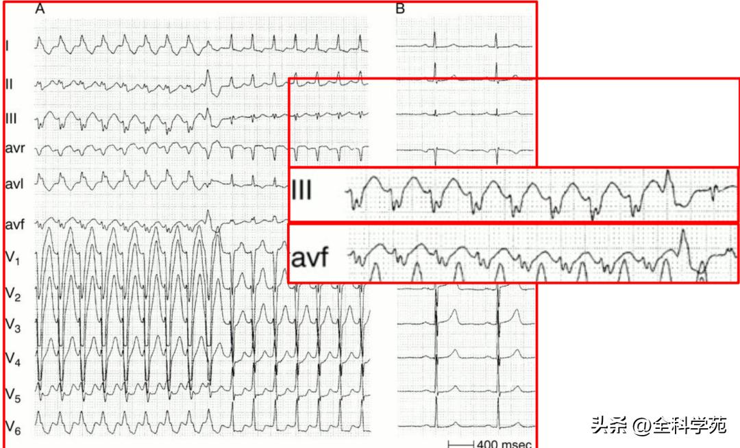 心电图上表现为宽qrs波,心电图中qrs是代表心动过速吗