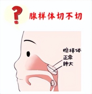 儿童分泌性中耳炎耳闷怎么缓解,分泌性中耳炎耳闷吃药11天没好转