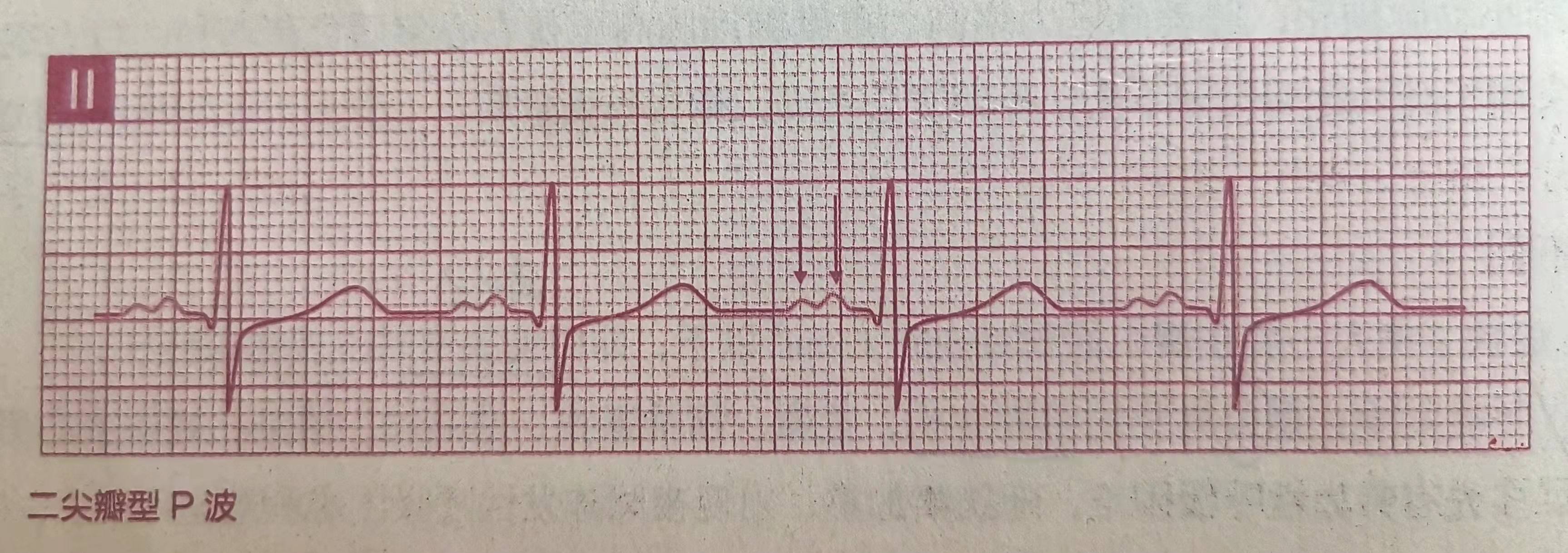 二尖瓣狭窄特征性表现,二尖瓣狭窄可以终身保守治疗吗
