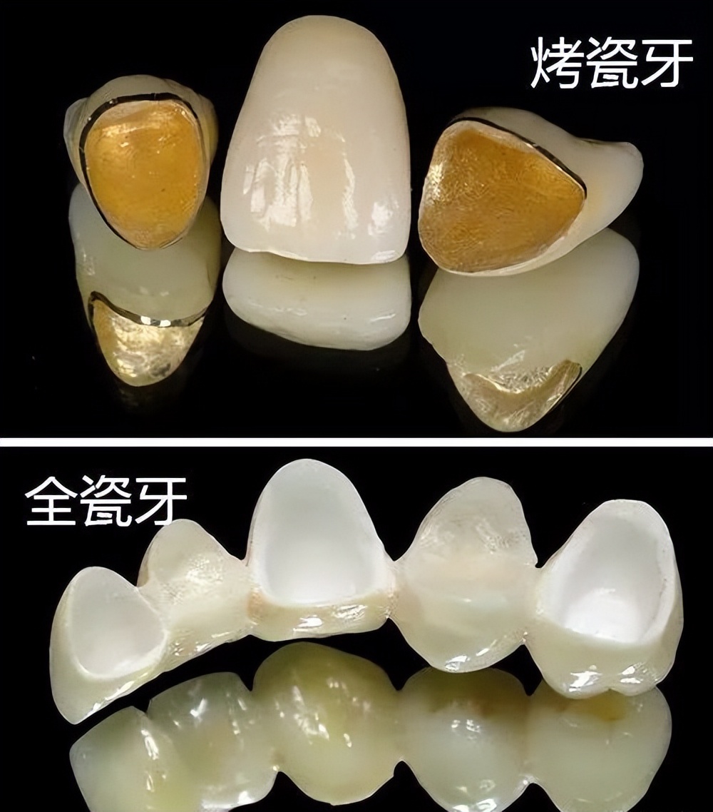 【AISR爱至情报所】假牙吃东西有风险，烤瓷牙裂了该怎么办？
