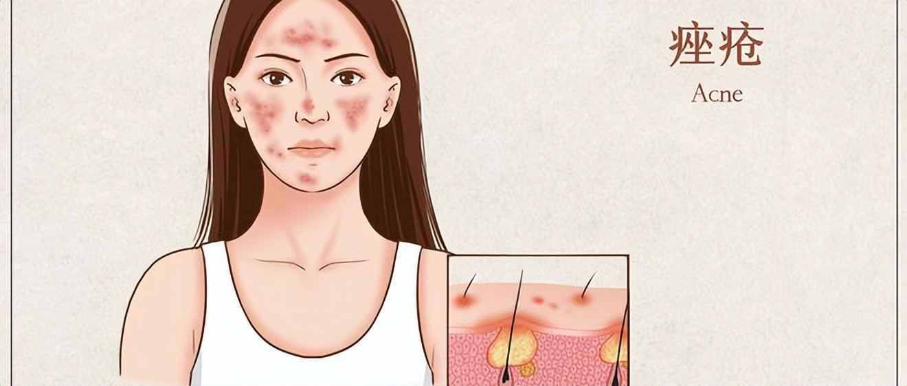 痘痘肌肤怎么形成的,痘痘肌肤问题及解决方法
