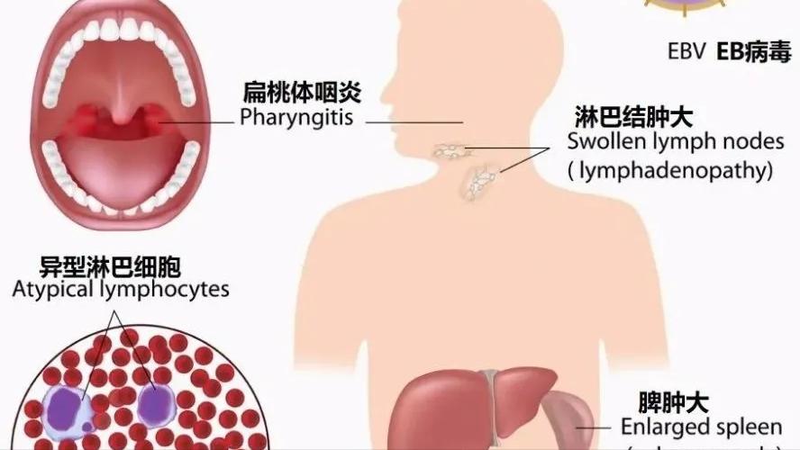 化脓性扁桃体炎一定要输液吗,化脓性扁桃体炎最怕三种水果