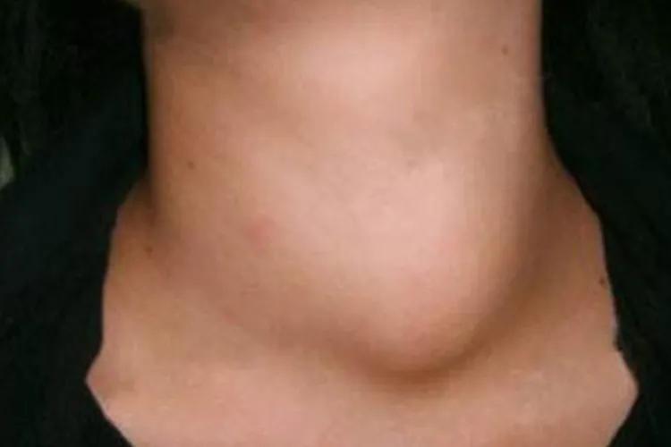 甲亢病是什么症状图片大全,甲亢病眼睛有什么症状