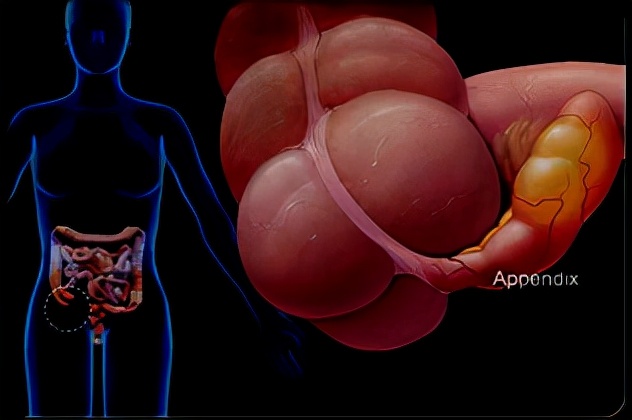 怀孕早期发现有阑尾炎怎么办,怀孕得阑尾炎怎么办胎儿能要吗