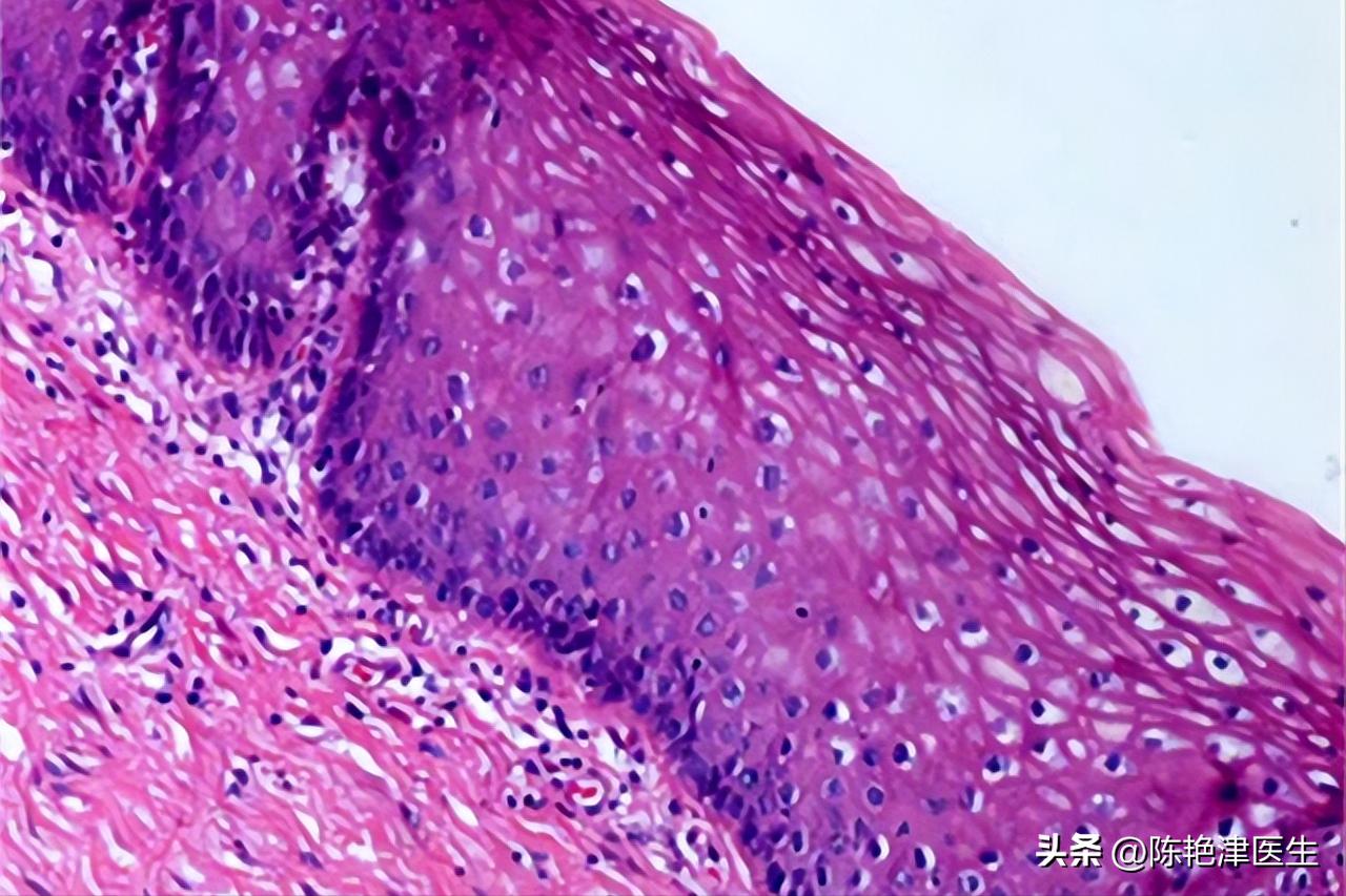 赵忠祥鳞状细胞癌早期症状,赵忠祥鳞状细胞癌有什么症状