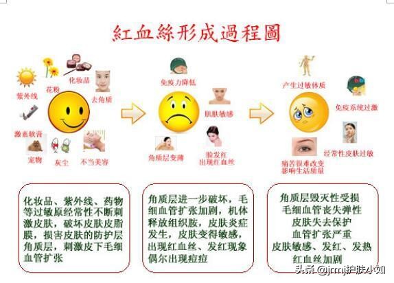 脸部红血丝怎么去除最好的方法,脸部红血丝怎么去除小妙招视频