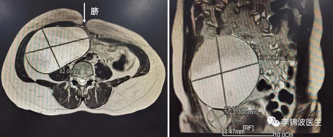 当患者问巨大卵巢囊肿能不能微创治疗时，医生是如何思考的？