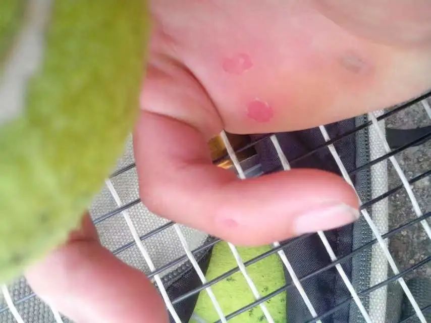 网球运动员腰椎间盘突出,网球肘和腰椎间盘突出