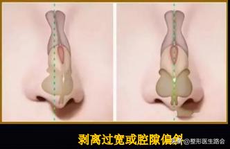隆鼻后为什么没用夹板,隆鼻后鼻头感觉有点歪怎么办