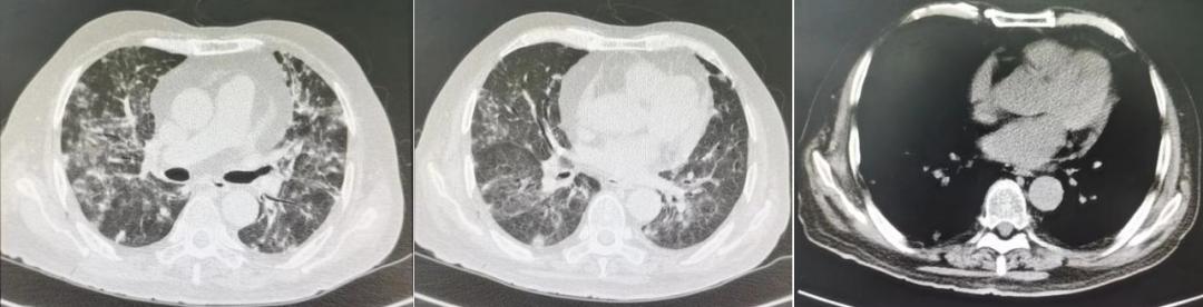 感染后稍微活动喘胸闷心悸,pjp感染