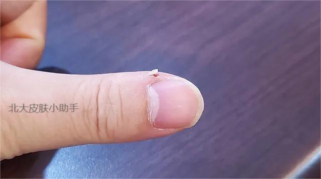 手贱喜欢抠指甲怎么办,撕掉手指甲盖死皮