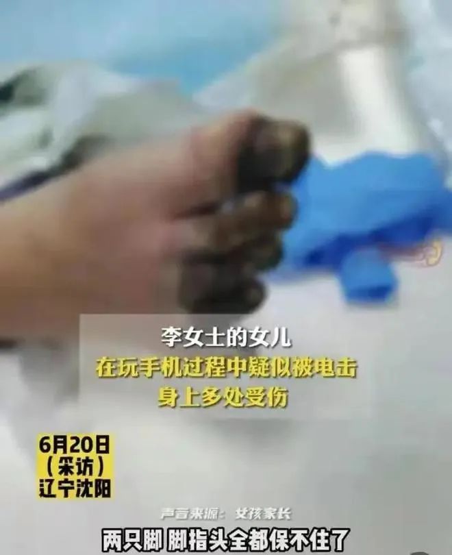女孩充电被电击内脏受损,女孩充电被电击内脏受损面临截肢