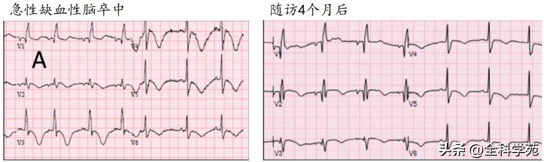 t波倒置三种常见原因,t波低平倒置有事吗