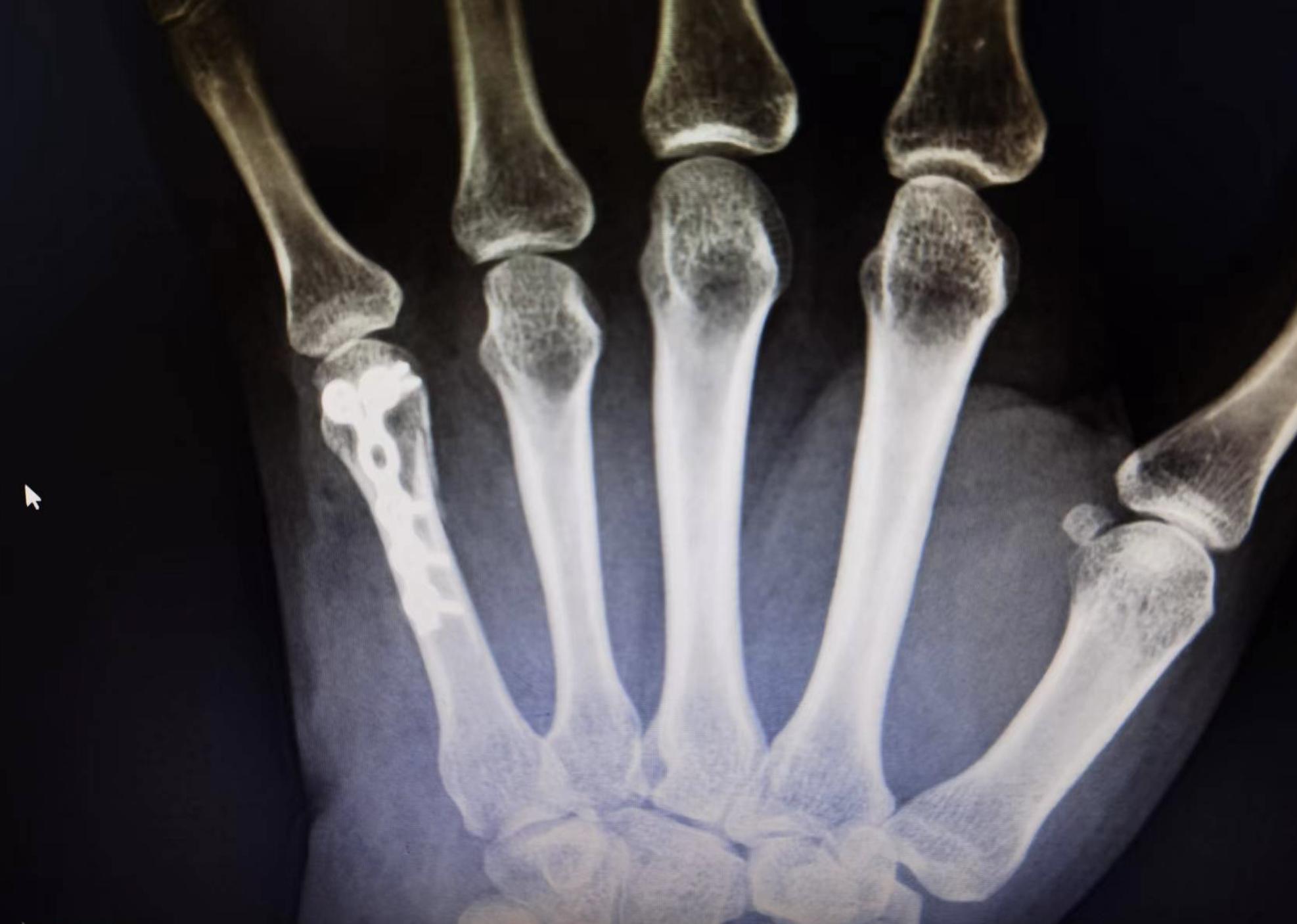 女子手被撞骨折,女孩被撞头部骨折后续