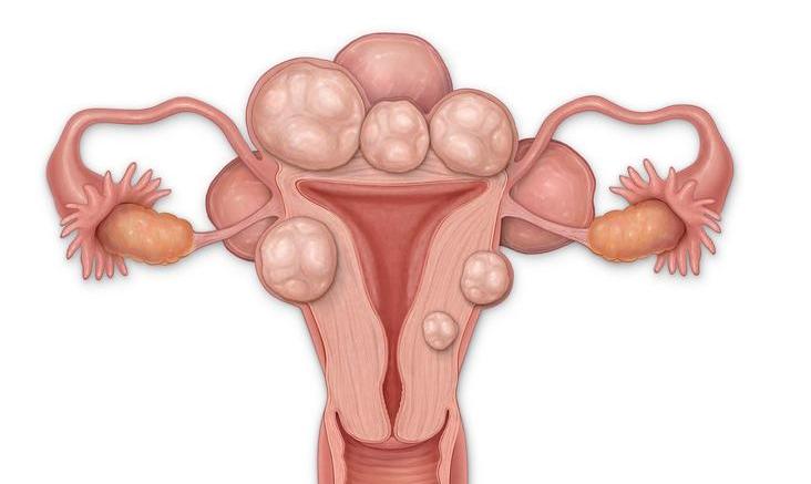 定期筛查宫颈癌有多重要？