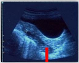 宫外孕孕妈会有危险吗,孕早期宫外孕会有什么症状和危害