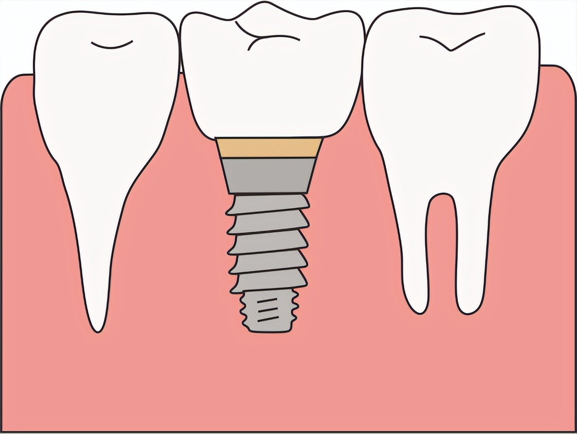 种植体长度12毫米会不会碰到神经,种植体离神经几毫米安全