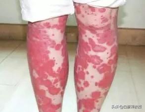 银屑病变成红皮病的原因,红皮病银屑病用什么药膏