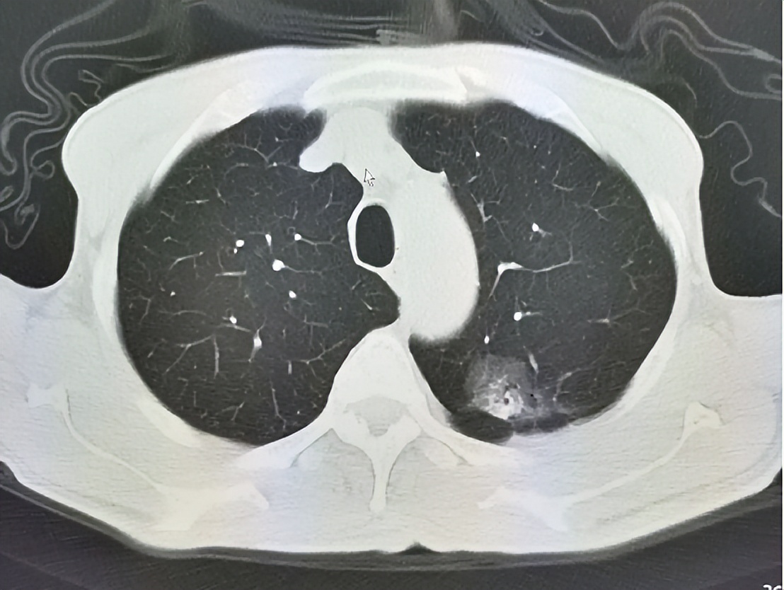 磨玻璃结节癌变早期肺癌能根治吗,纯磨玻璃结节7mm肺癌的可能有多大