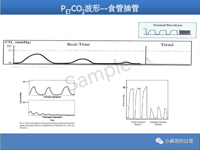 呼气末二氧化碳检测图的解读,呼气末二氧化碳检测操作视频