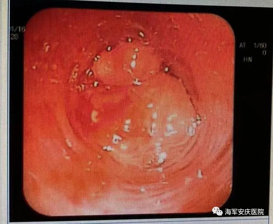 为何阳康后仍觉胸闷气短有痰,阳康后胸闷是什么感觉