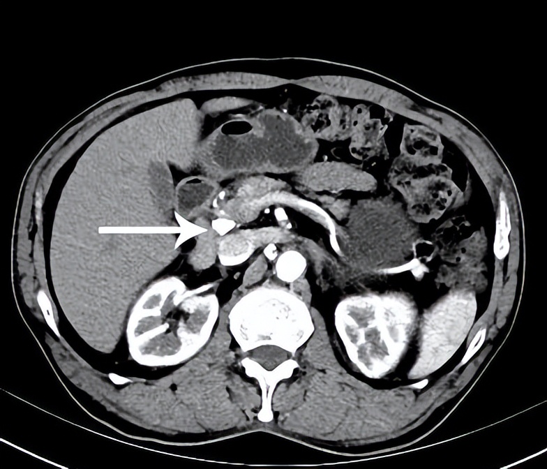 粒子植入适合腹膜后淋巴结吗,腹膜后淋巴结转移化疗效果