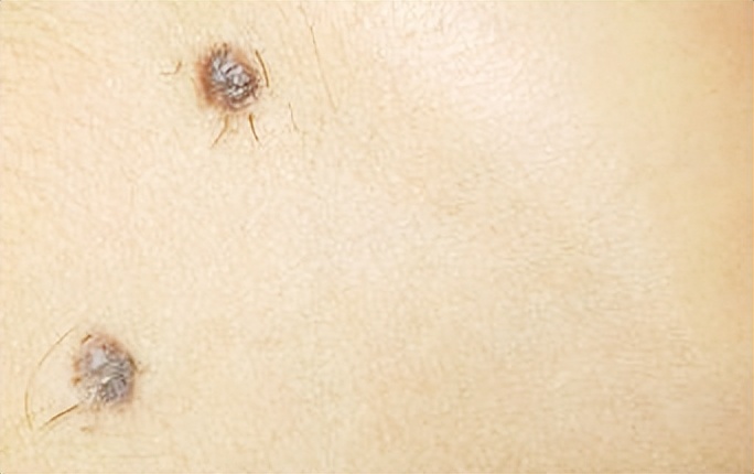 如何判断新长的痣是不是黑色素瘤,正常痣和黑色素痣图片对比说明