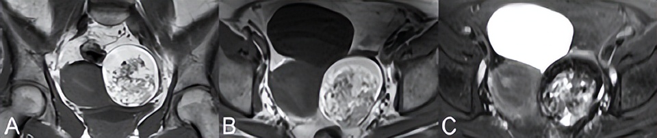 卵巢良性病变mri诊断思路,核磁共振可以看出卵巢病变吗