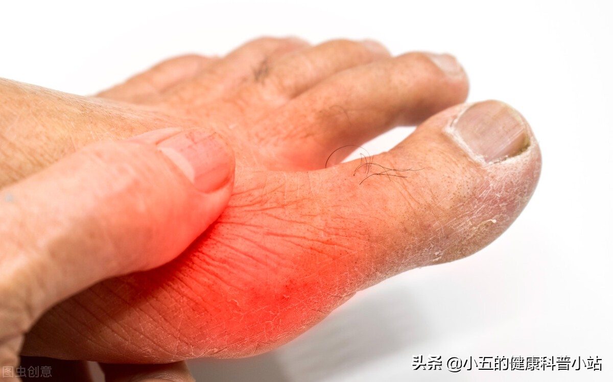 非布司他怎么吃可以根治痛风,吃非布司他痛风发作脚红肿怎么办