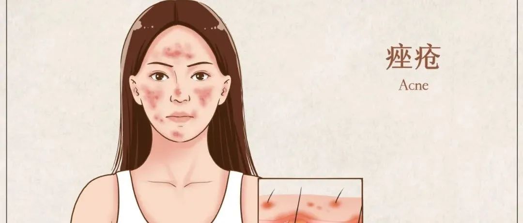 囊肿青春痘怎么治,青春痘肉疙瘩怎么治