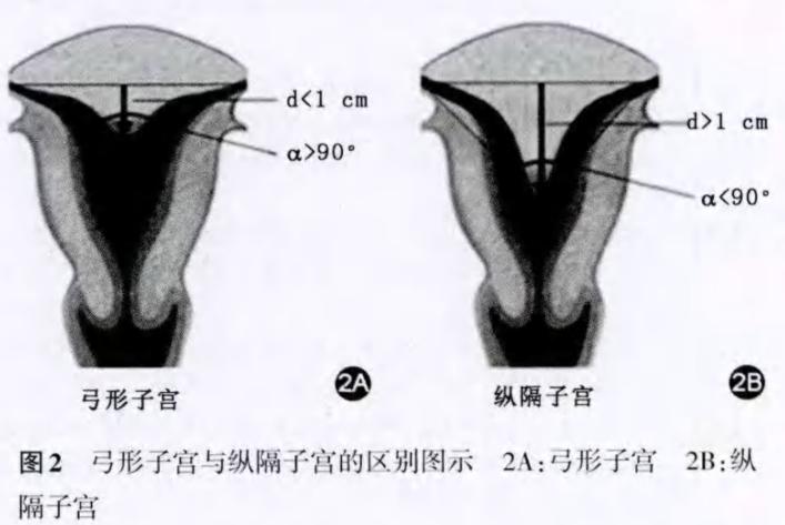 纵隔子宫对怀孕有影响吗,纵隔子宫需要治疗吗