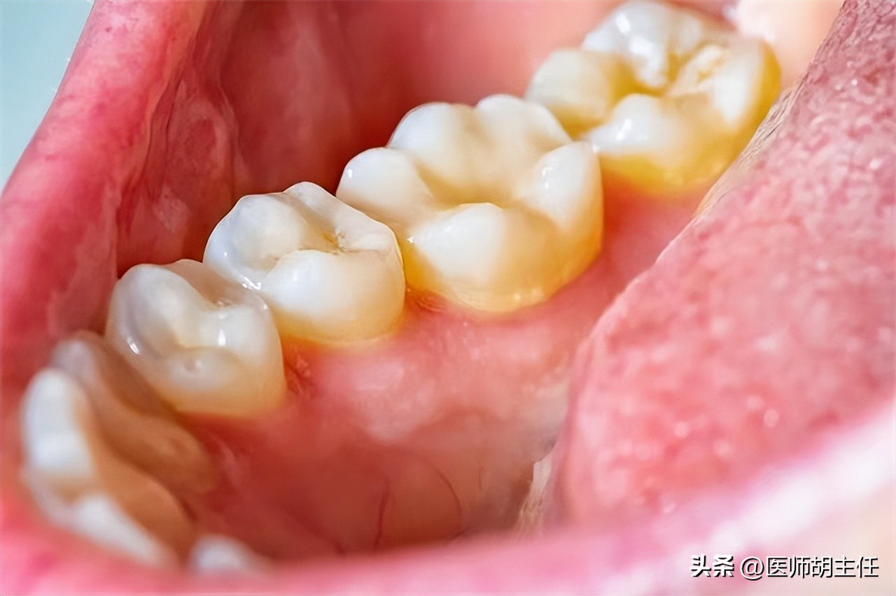 清理牙缝牙结石最有效方法,如何清除牙缝里的牙结石